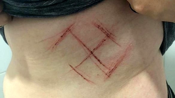 Jovem de 19 anos tem suástica marcada na pele a canivete, em Porto Alegre (Foto: Reprodução)