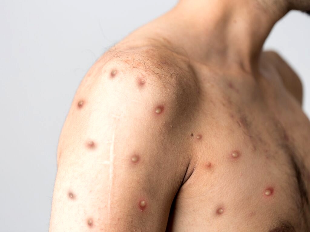 Varíola dos macacos (monkeypox) pode se manifestar com uma ou várias lesões na pele; no Brasil; vacina para a doença ainda não está disponível (Foto: Istock)