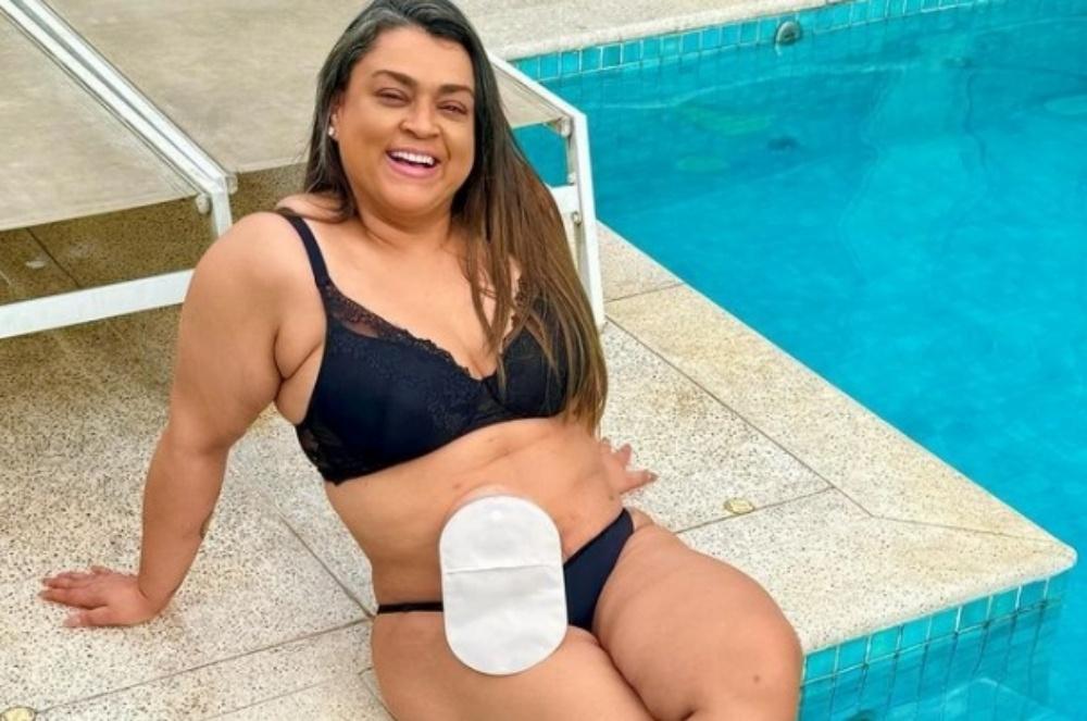 Preta Gil falou abertamente sobre o câncer. Na foto, aparece com a com bolsa de ileostomia (Foto: Instagram/Reprodução)